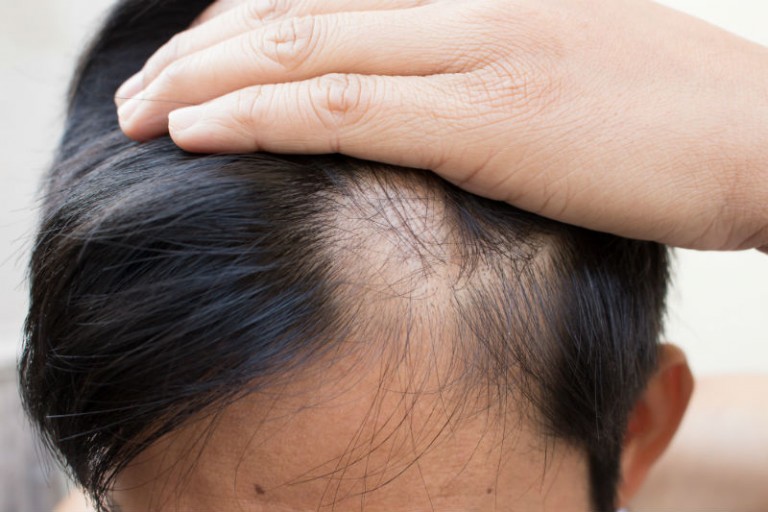 3 Effective, Long-lasting, and Proven Methods for Hair Restoration in CT