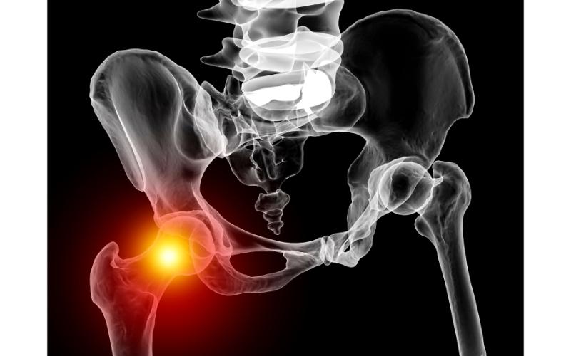 Getting Chiropractic Care after a Hip Replacement in Round Rock, TX